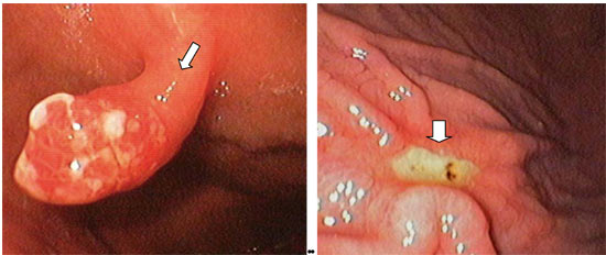 blutung-magengeschwuer